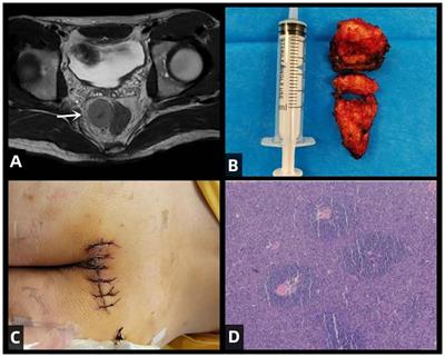 A rare case report of hyaline-vascular type Castleman disease in the presacral region